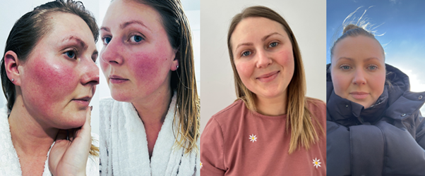 Bianca Storer before and after using Kalme Day Defence and Kalme Chameleon Concealer